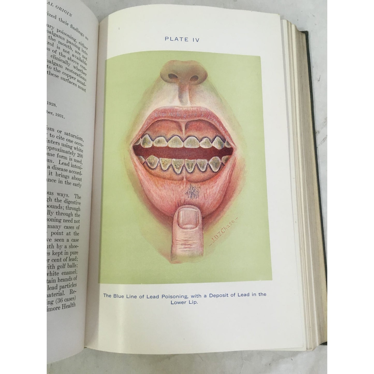 Diseases of the Mouth and Their Treatment Book by Prinz/Greenbaum