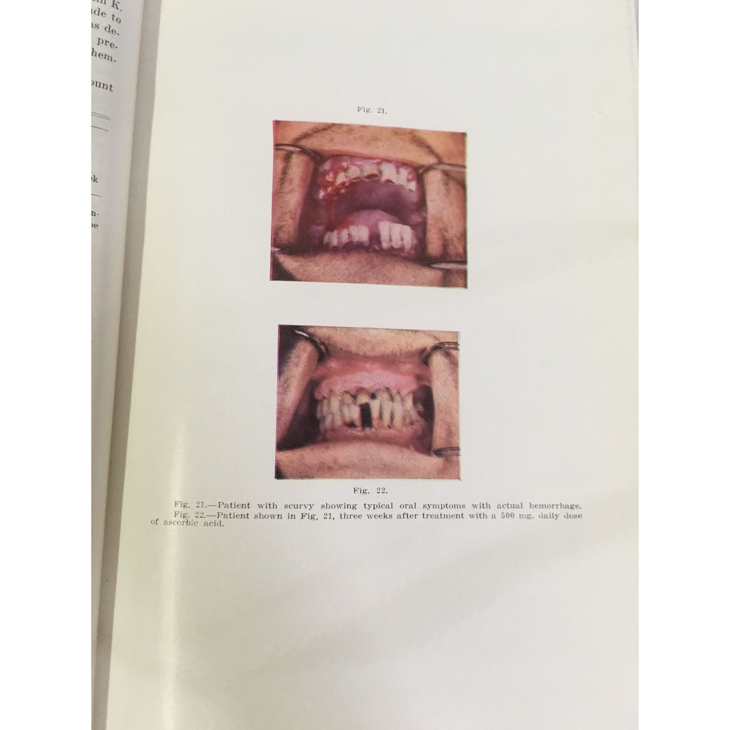 Oral Surgery Volume 1 Second Edition Hardcover Book